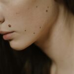 Detailed close-up of a woman's face, focusing on skin with multiple moles.